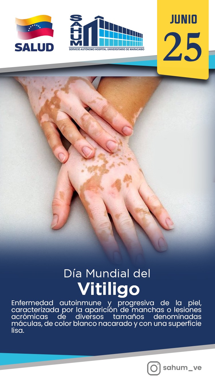 Vitiligo