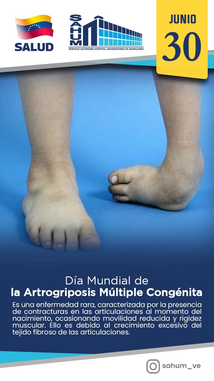 Artrogriposis Multiple Congénita